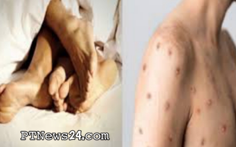 Is Monkeypox Really an STD?: Experts क्या कहते हैं? | Symtoms & Prevention |